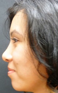2004 Rhinoplasty-6 Months After