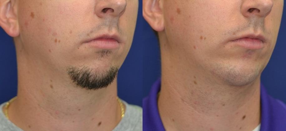 chin augmentation