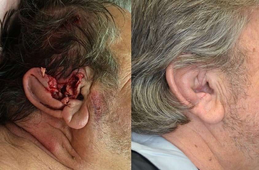 Ear Amputation