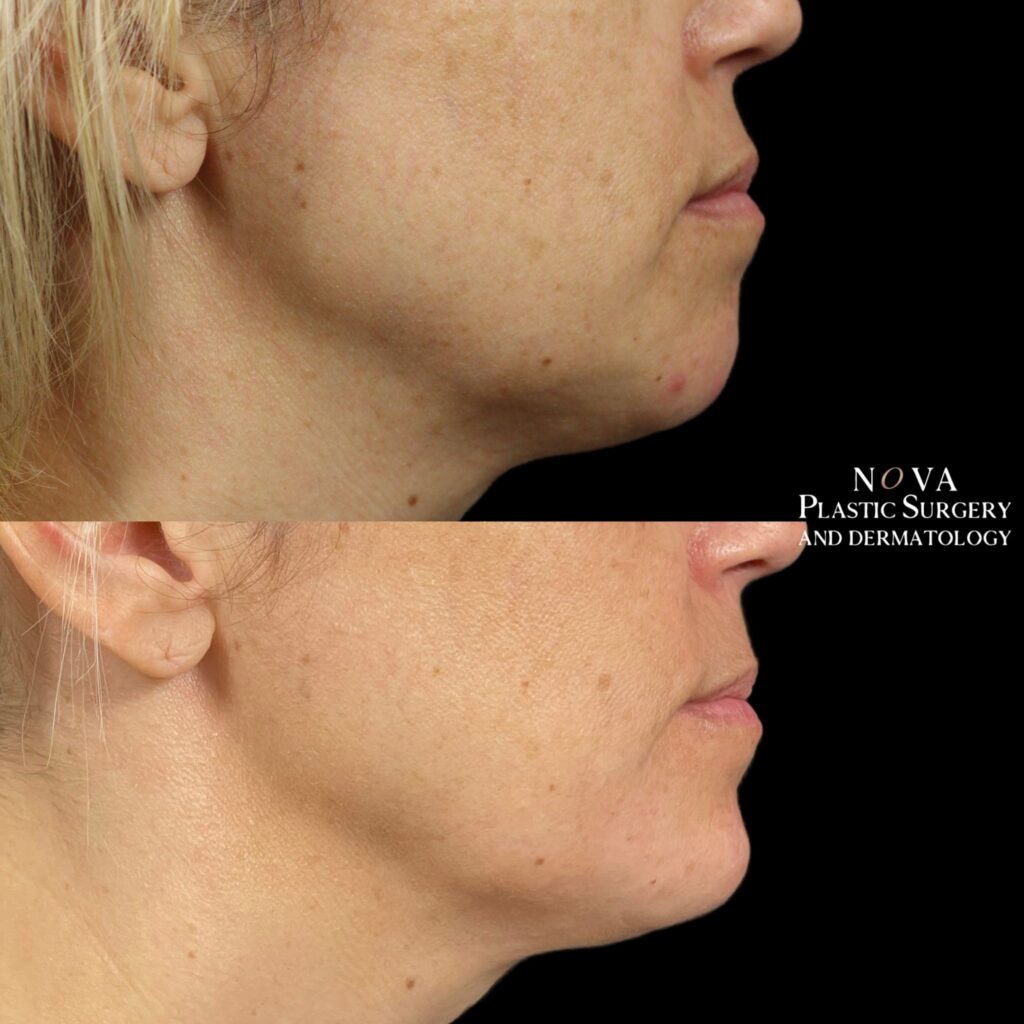 before and after of a NOVA Plastic Surgery and Dermatology chin filler patient. Results may vary.