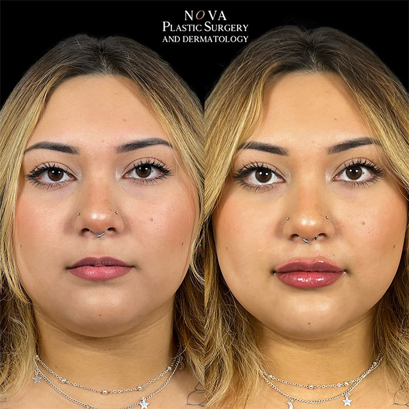 before and after lip filler treatment
