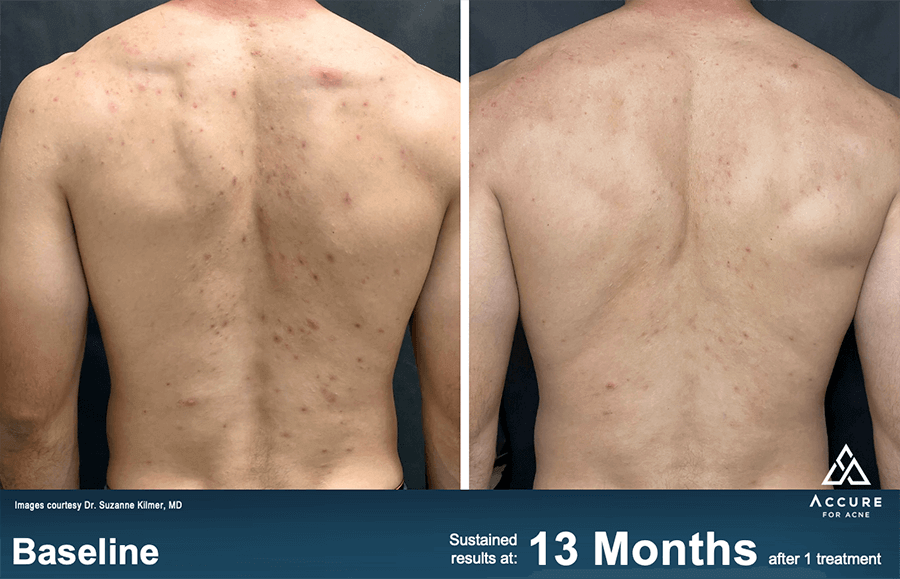 Accure Laser Acne Treatment Patient Results 1