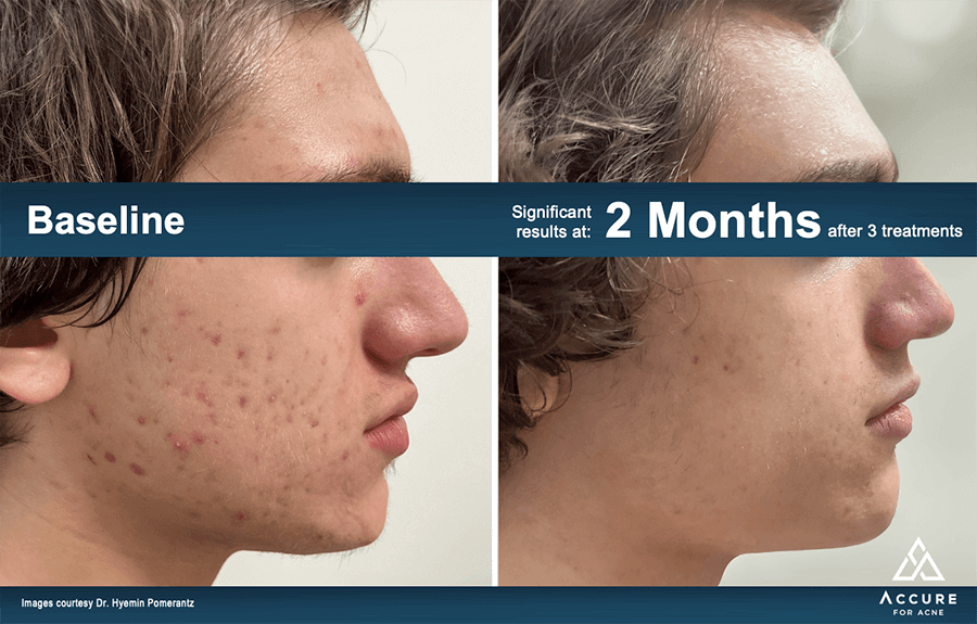 Accure Laser Acne Treatment Patient Results 6