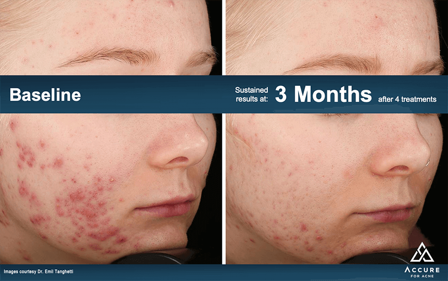Accure Laser Acne Treatment Patient Results 2