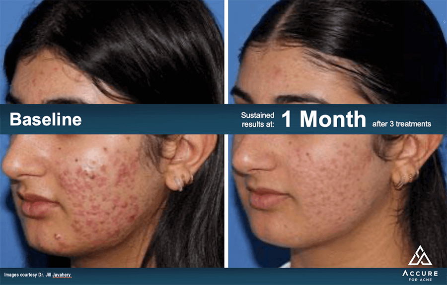 Accure Laser Acne Treatment Patient Results 3