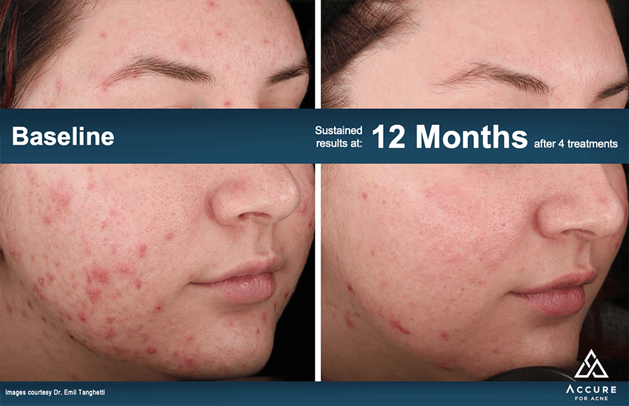 Accure Laser Acne Treatment Patient Results 4