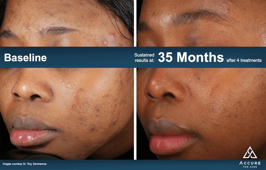 Accure Laser Acne Treatment Patient Results 5