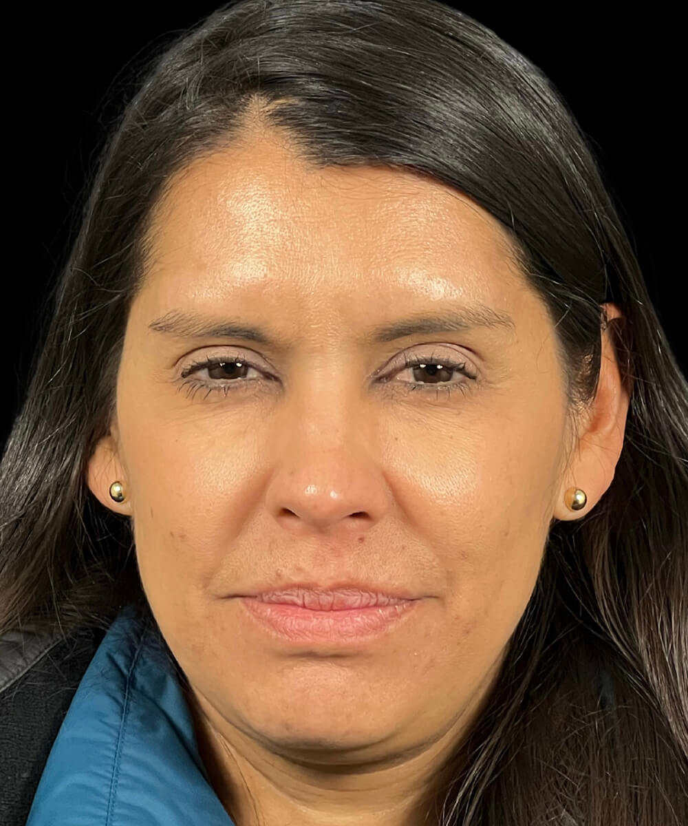 Case--2417 | After BOTOX® Cosmetic/Dysport®