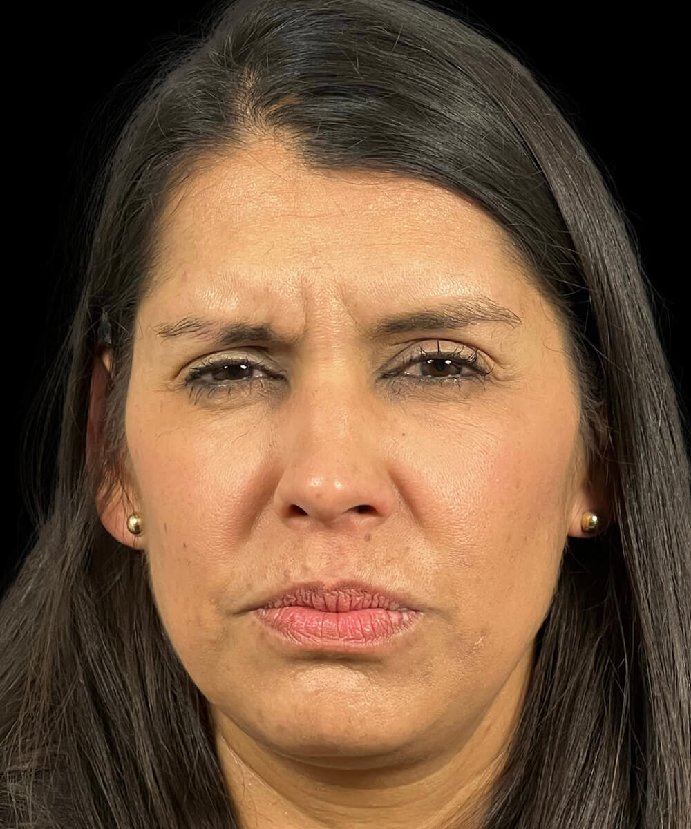 Case--2417 | Before BOTOX® Cosmetic/Dysport®