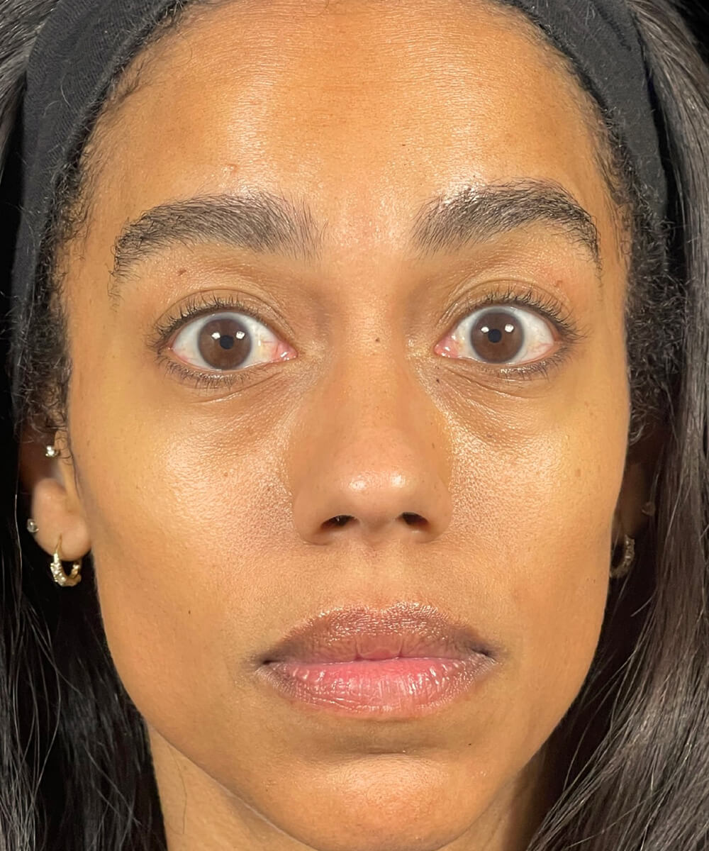 Case--1165 | After BOTOX® Cosmetic/Dysport®