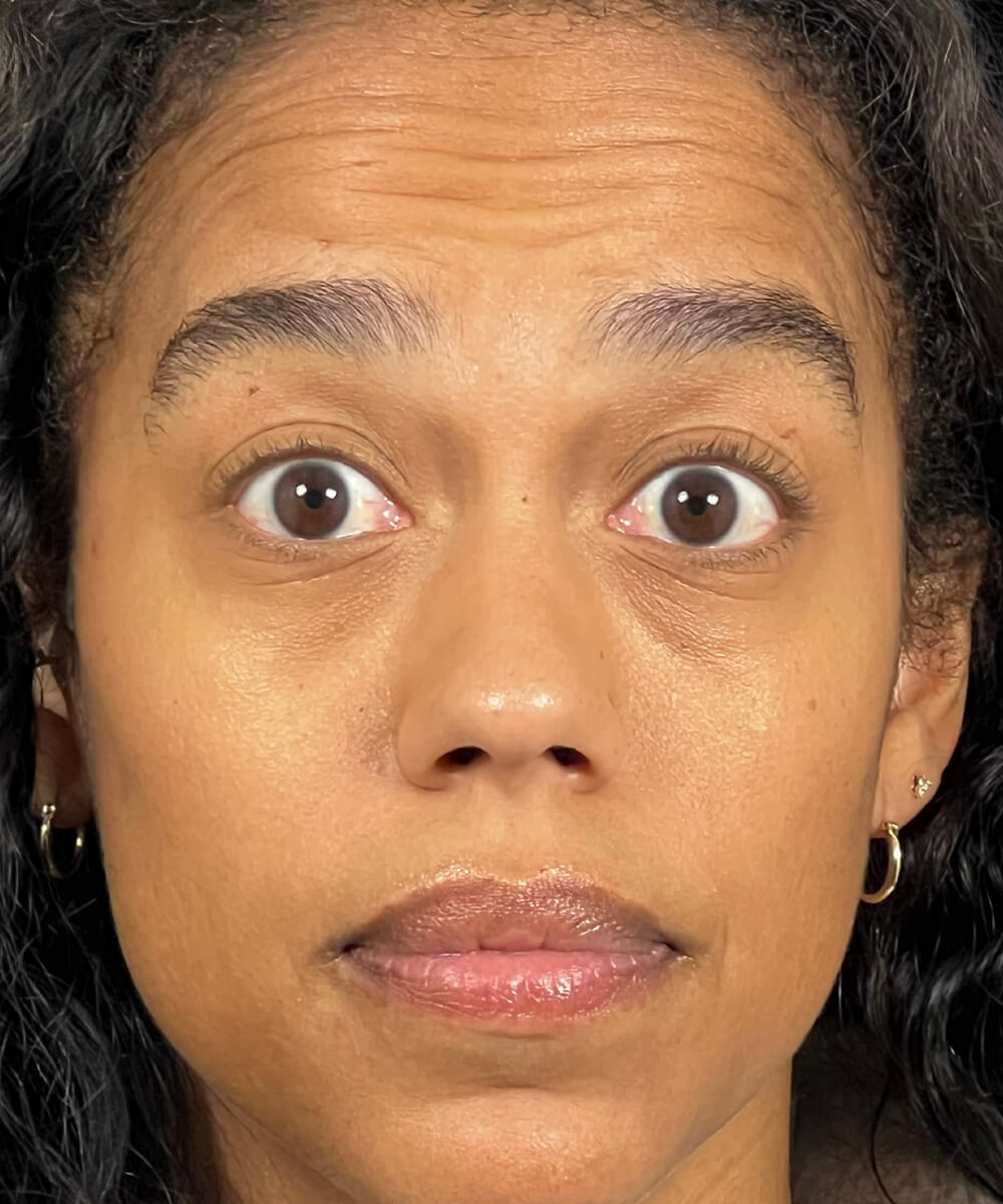 Case--1165 | Before BOTOX® Cosmetic/Dysport®