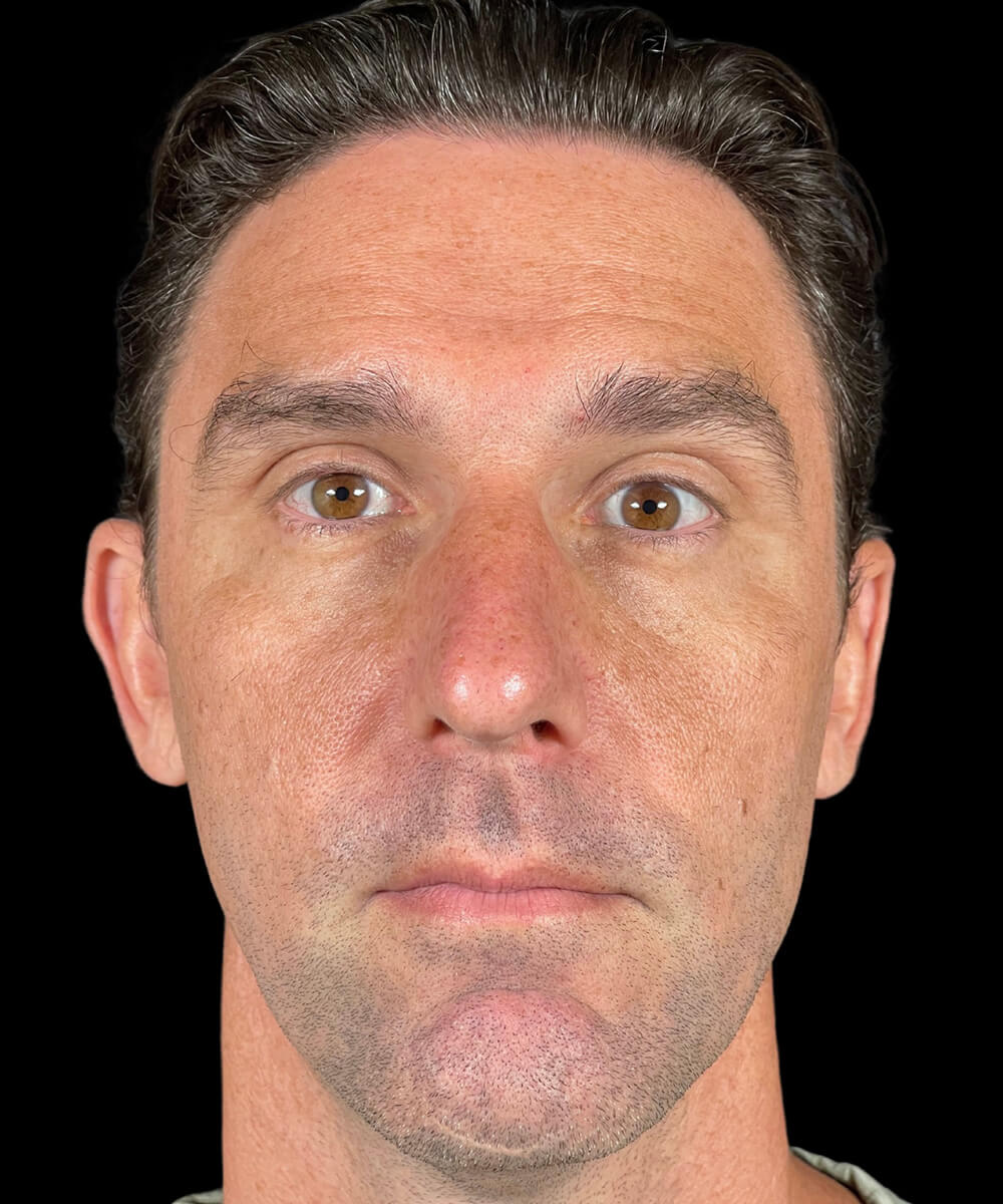 Case--6263 | After BOTOX® Cosmetic/Dysport®