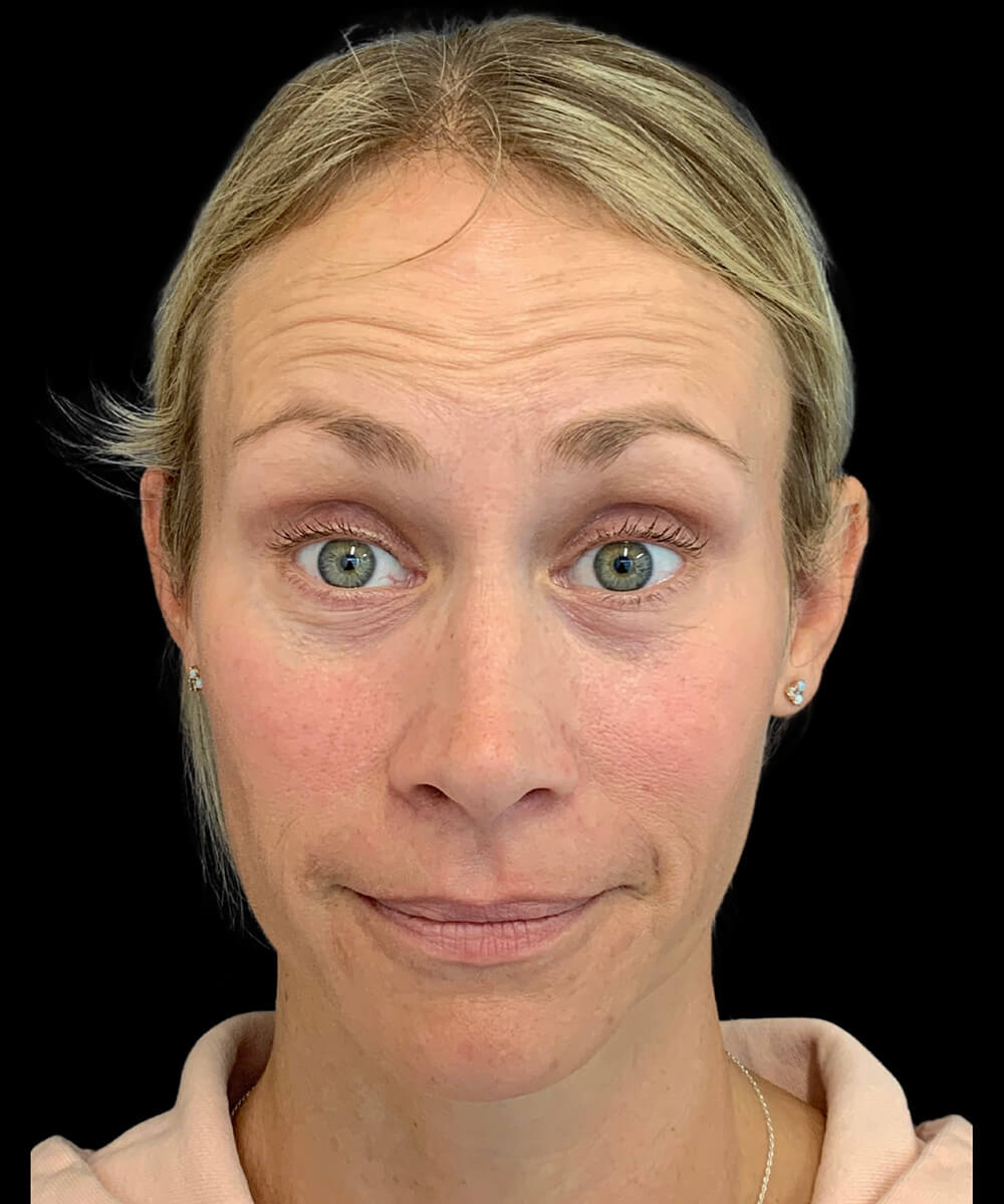 Case--9145 | Before BOTOX® Cosmetic/Dysport®