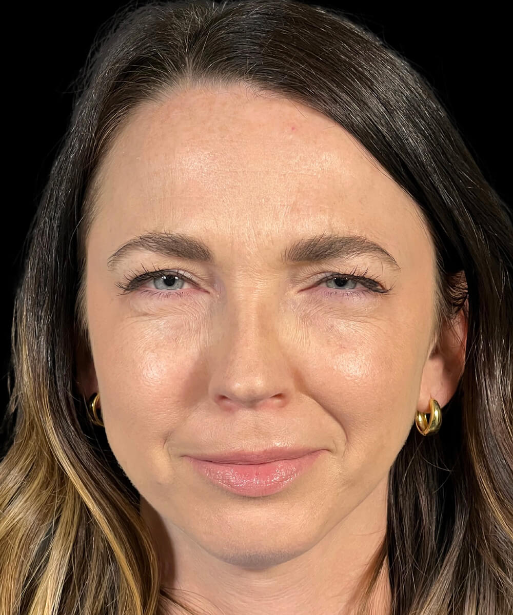 Case--3640 | After BOTOX® Cosmetic/Dysport®