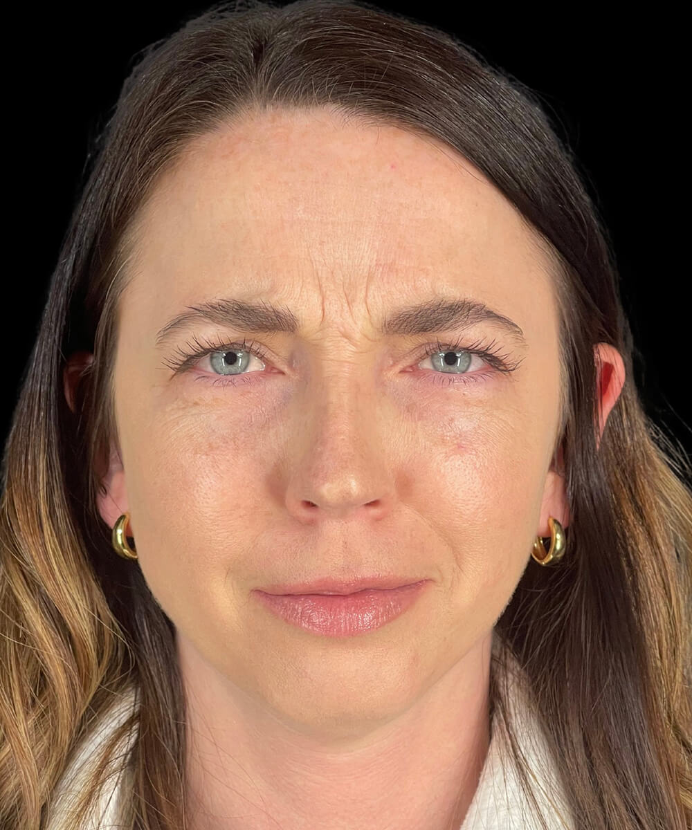 Case--3640 | Before BOTOX® Cosmetic/Dysport®