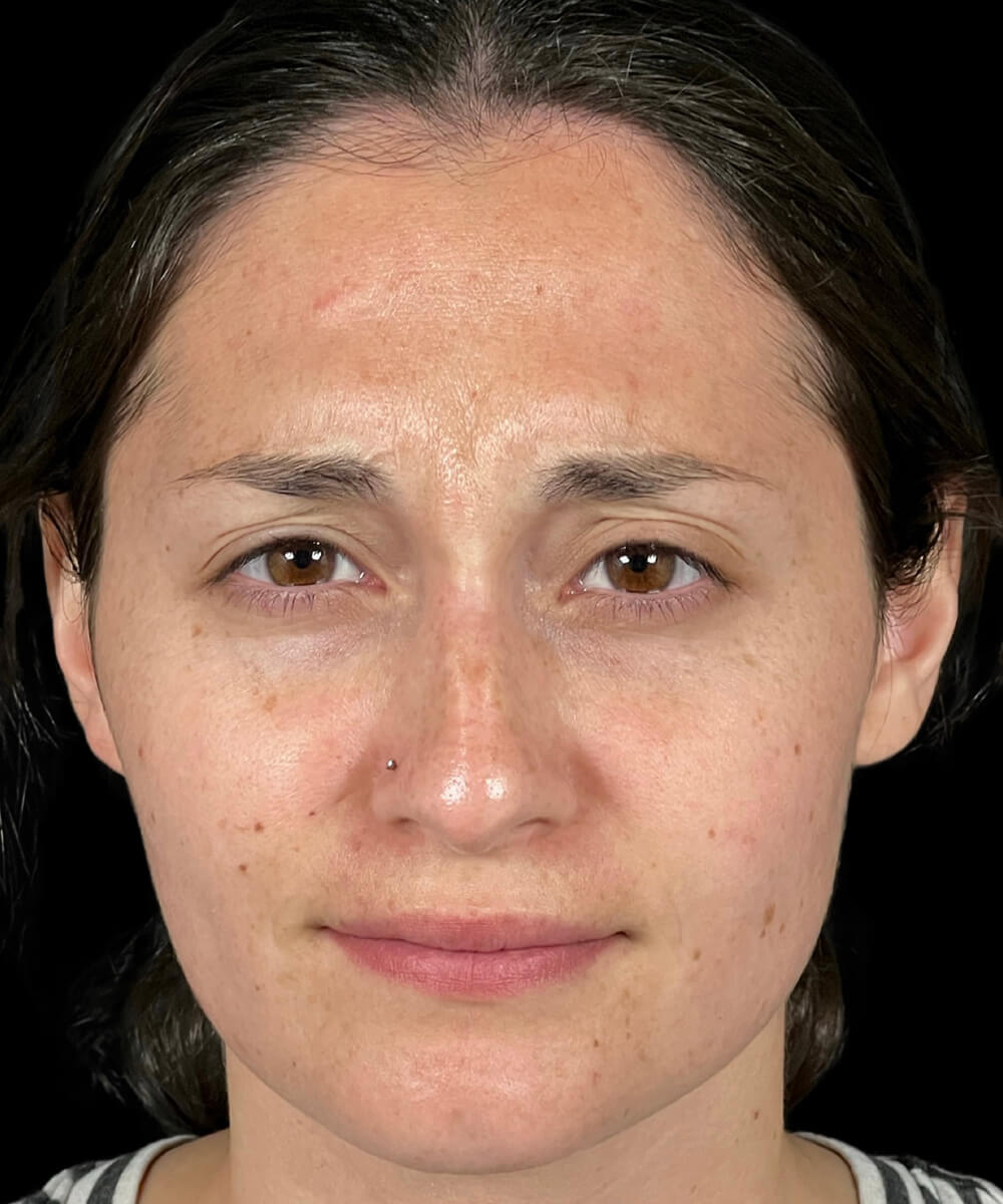 Case--2879 | After BOTOX® Cosmetic/Dysport®