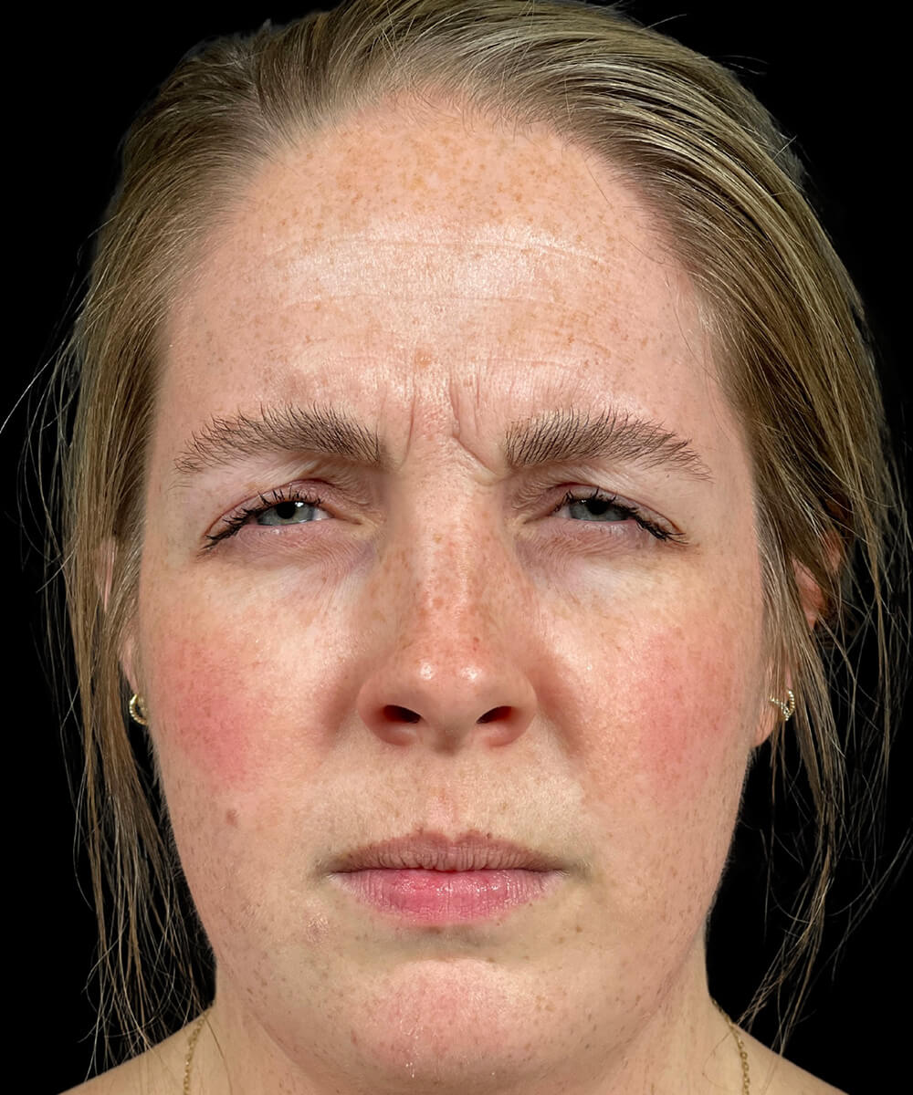 Case--6683 | Before BOTOX® Cosmetic/Dysport®