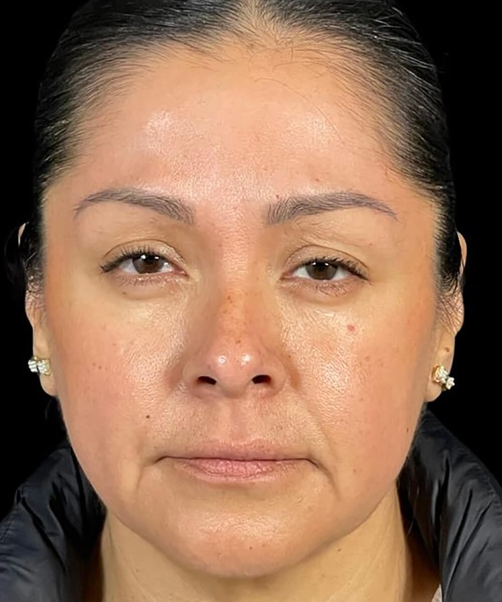 Case--8171 | After BOTOX® Cosmetic/Dysport®