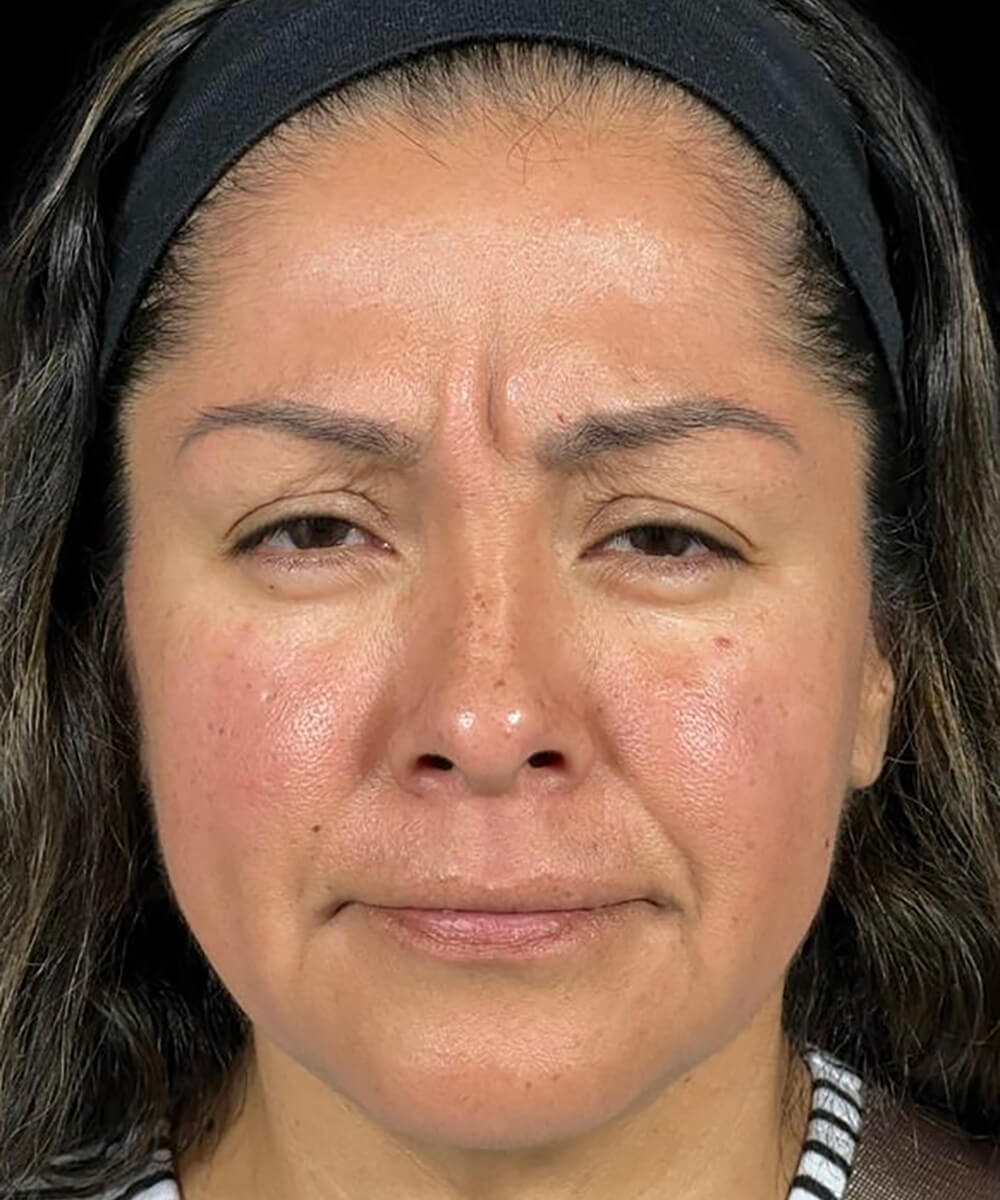 Case--8171 | Before BOTOX® Cosmetic/Dysport®